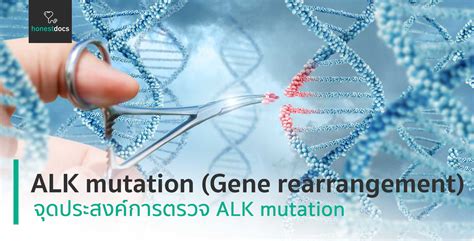 ALK mutation (Gene rearrangement) | HD สุขภาพดี เริ่มต้นที่นี่