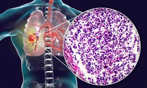 Imfinzi approved in EU to treat extensive-stage small cell lung cancer