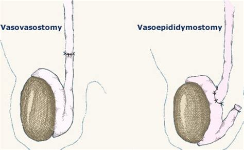 What kind of vasectomy reversal will you need (vasovasostomy or vasoepididymostomy)? - Austin ...