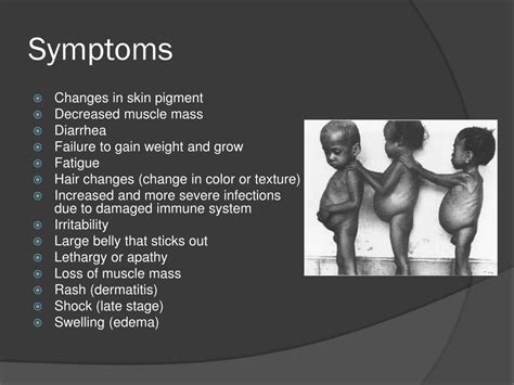 PPT - Kwashiorkor PowerPoint Presentation, free download - ID:2124446