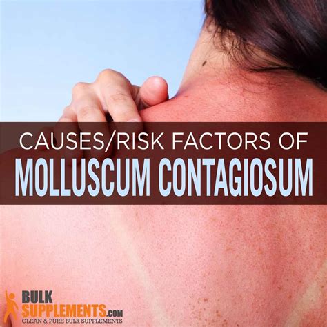 Molluscum Contagiosum: Symptoms, Causes & Treatment