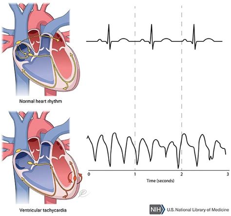 Catecholaminergic polymorphic ventricular tachycardia: MedlinePlus Genetics