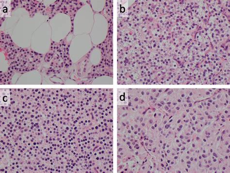 Parathyroid Adenoma Histology