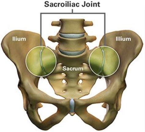 Sacro-Iliac Joint Dysfunction - Spines Dorset