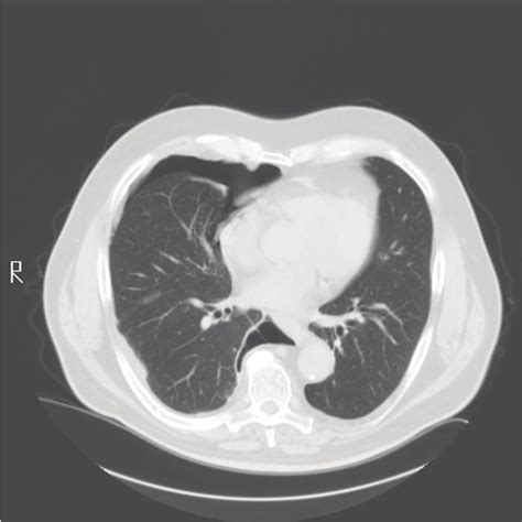 Chest CT scan in August 2008 showing a large right pneumothorax with... | Download Scientific ...