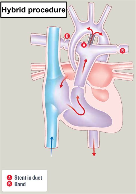 Hypoplastic Left Heart Syndrome - Causes, Prognosis, Surgery, Treatment