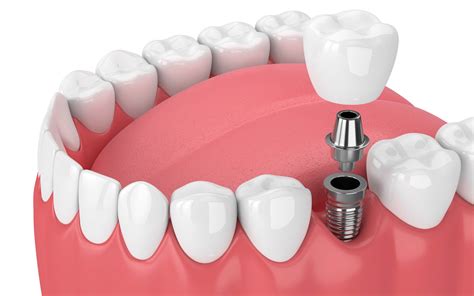 Dental Implants | Dental Implant Specialists | Beechview Dental