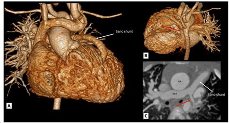 A TOF patient with Sano shunt. a, b 3D VRT and c a reformatted axial ...