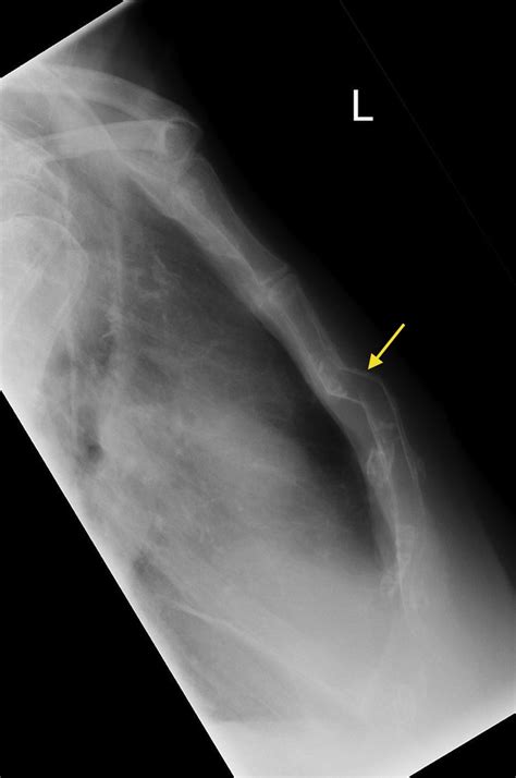 Sternal fracture - Radiology at St. Vincent's University Hospital