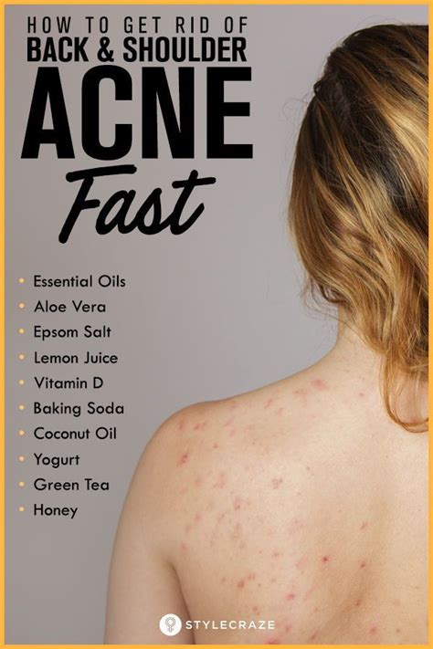 Home Remedies For Back Acne + Causes, Treatment, And Prevention Tips ...