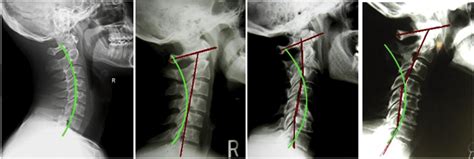 Spinal Degeneration Phases | Zimmerman Family Wellness | Cornelius, NC