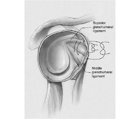 The rotator interval repair performed for the study. Two No. 2... | Download Scientific Diagram