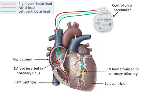 In CRT or Biventricular pacemaker, a left ventricular lead is implanted ...