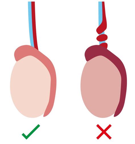 Torsion of testicles (twisted balls) - Resource Library - Sheffield Children's NHS Foundation Trust