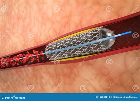 Balloon Angioplasty Procedure Stock Illustration - Illustration of block, coronary: 157803213