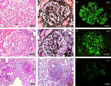 Membranous Nephropathy Histology