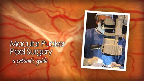 What is retinal pucker surgery?