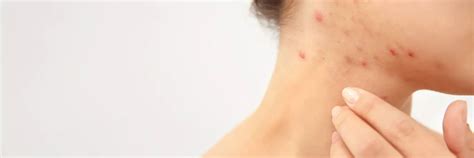 5 Simple Ways To Get Rid of Pimples on Neck | Euromed Clinic