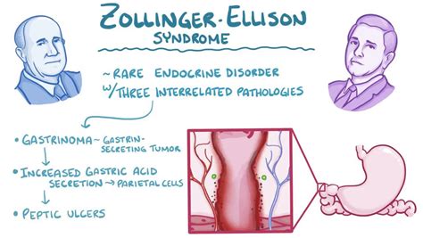 Zollinger-Ellison syndrome: Video, Anatomy & Definition | Osmosis