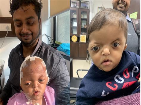 Neurosurgeons In Gurugram Reshape Skull Of A 9-Month-Old Baby Born With ...