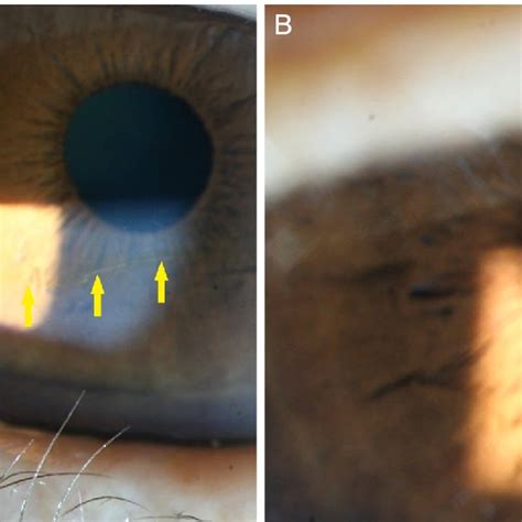 Stocker's line (slit-lamp photo). (A) A 64-year-old male diagnosed with ...