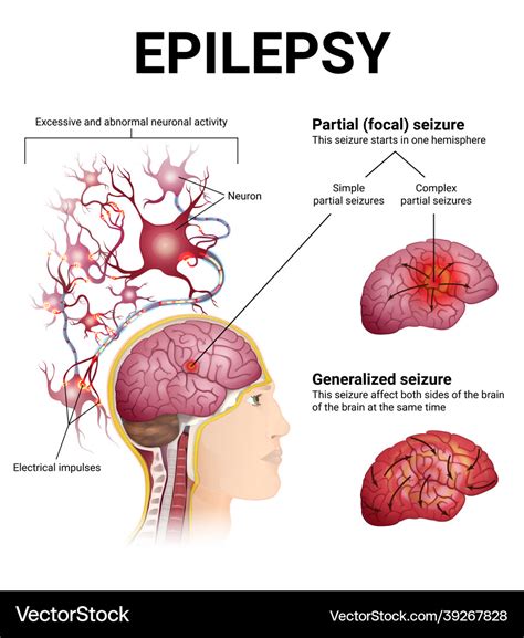 Epilepsy Brain Diagram