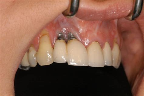 Dental Implant Problems - BPI Dental can provide the solutions