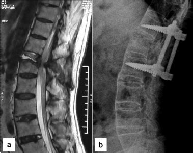 (A) MRI spine showing abnormally raised T2 hyperintensity in T12/L1... | Download Scientific Diagram