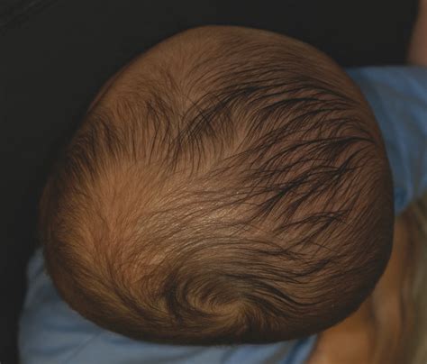 3 Deformational Plagiocephaly, Brachycephaly, and Scaphocephaly | Plastic Surgery Key