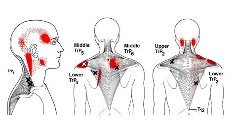 Dor Miofascial - Gustavo Nogueira - Osteopatia & Fisioterapia