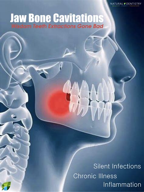 Dental Cavitations | Jaw Bone Infections