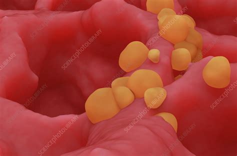 Lung cancer cells, illustration - Stock Image - F041/8466 - Science Photo Library