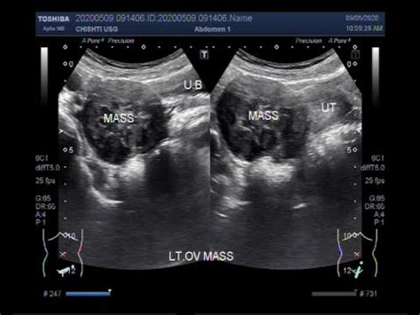 Ovarian Cancer Tumor Ultrasound