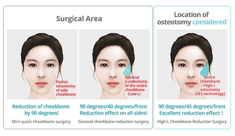 Ssurvivor: Malar Reduction Surgery