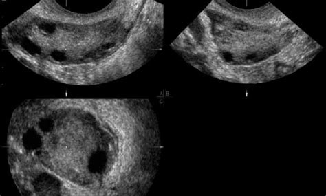 Three‐dimensional ultrasound improves the interobserver reliability of antral follicle counts ...