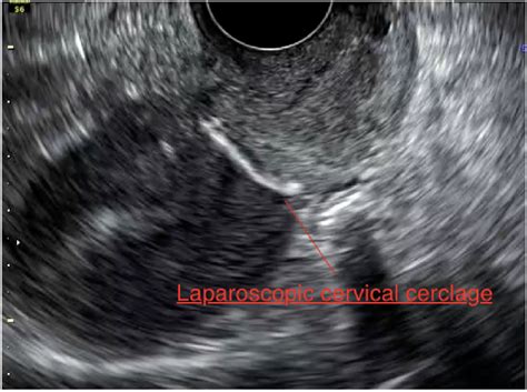 Ultrasound image of the inserted cervical cerclage. | Download Scientific Diagram