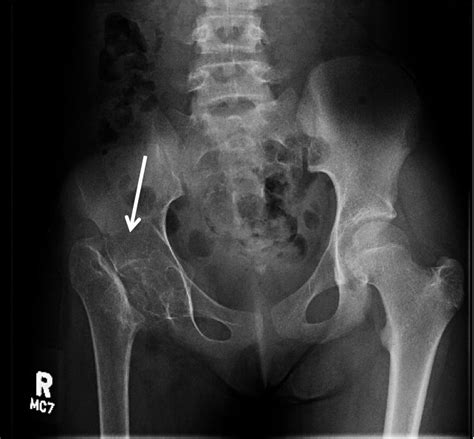 Peds Femoral Neck Frature. AP XRay. Annotated. JETem 2020 - JETem