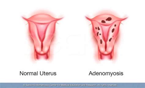 Focal Adenomyosis Ultrasound