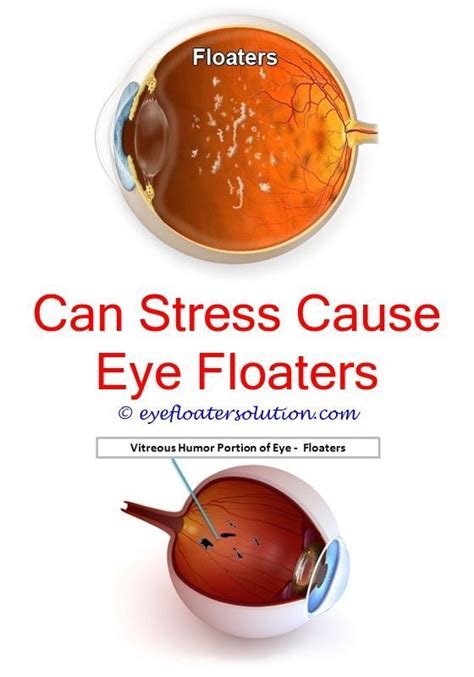 black floaters in eyes causes - can floaters be removed from your eyes.what cuases eye floaters ...