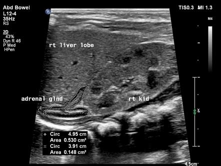 Normal adrenal glands - neonatal (ultrasound) | Image | Radiopaedia.org