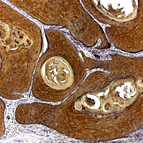 Computed tomography scan showing the perforated caecal carcinoma and... | Download Scientific ...