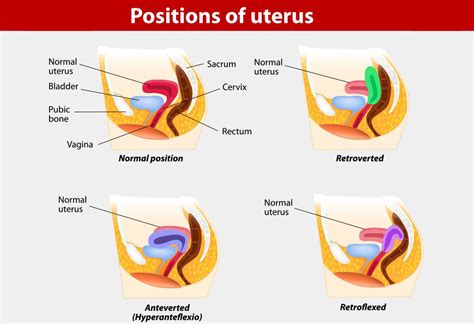 Anteverted uterus