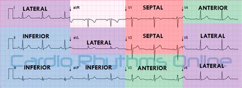 CVT Mohd Farid: ECG & Echocardiography Case Study Chronic Myocardial Infarction-Credit Cardio ...