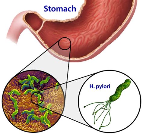 Natural H. Pylori Treatment and a Brief Overview of its Ill Health Effects & the Scientific ...