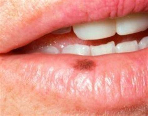 Black Spot on Lips? What’s That About Then? | HubPages