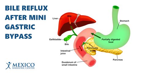 bilirubin Archives - Mexico Bariatric Center