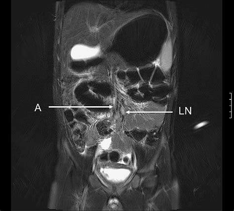 Whole Body Pet Mri Fusion Showing Para Aortic Lymph Node Metastasis | Hot Sex Picture