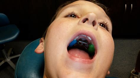 Palatal Expanders: What They Help... and How | Lakewood Dentist