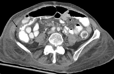 A 39-year-old woman presented with a left iliac fossa mass ...