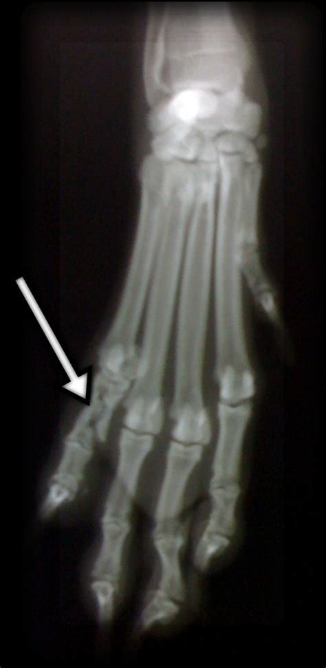 Broken Toe X Ray